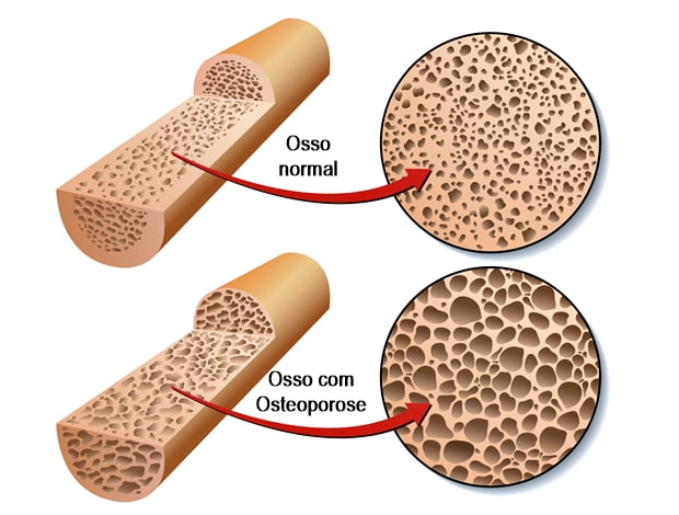 Osteoporose - Causas, sintomas e tratamentos