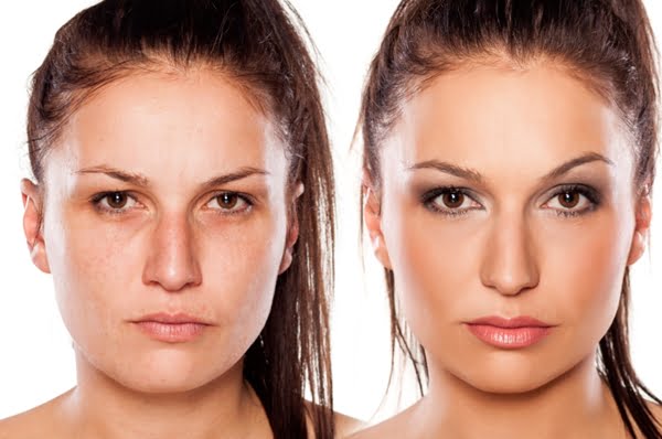 Botox no rosto contra rugas: confira antes e depois