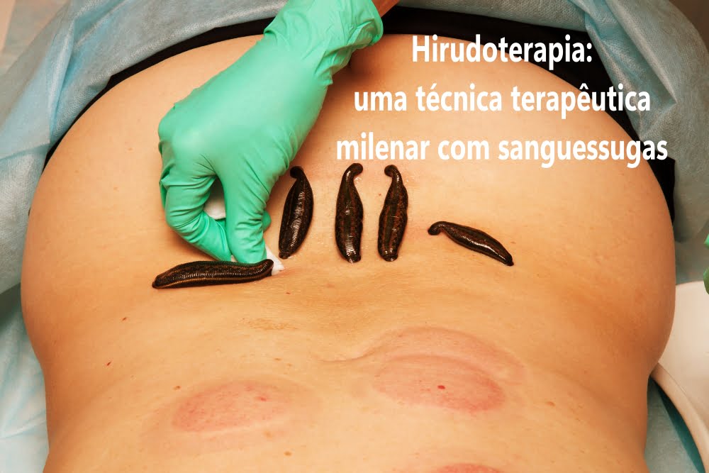 Hirudoterapia